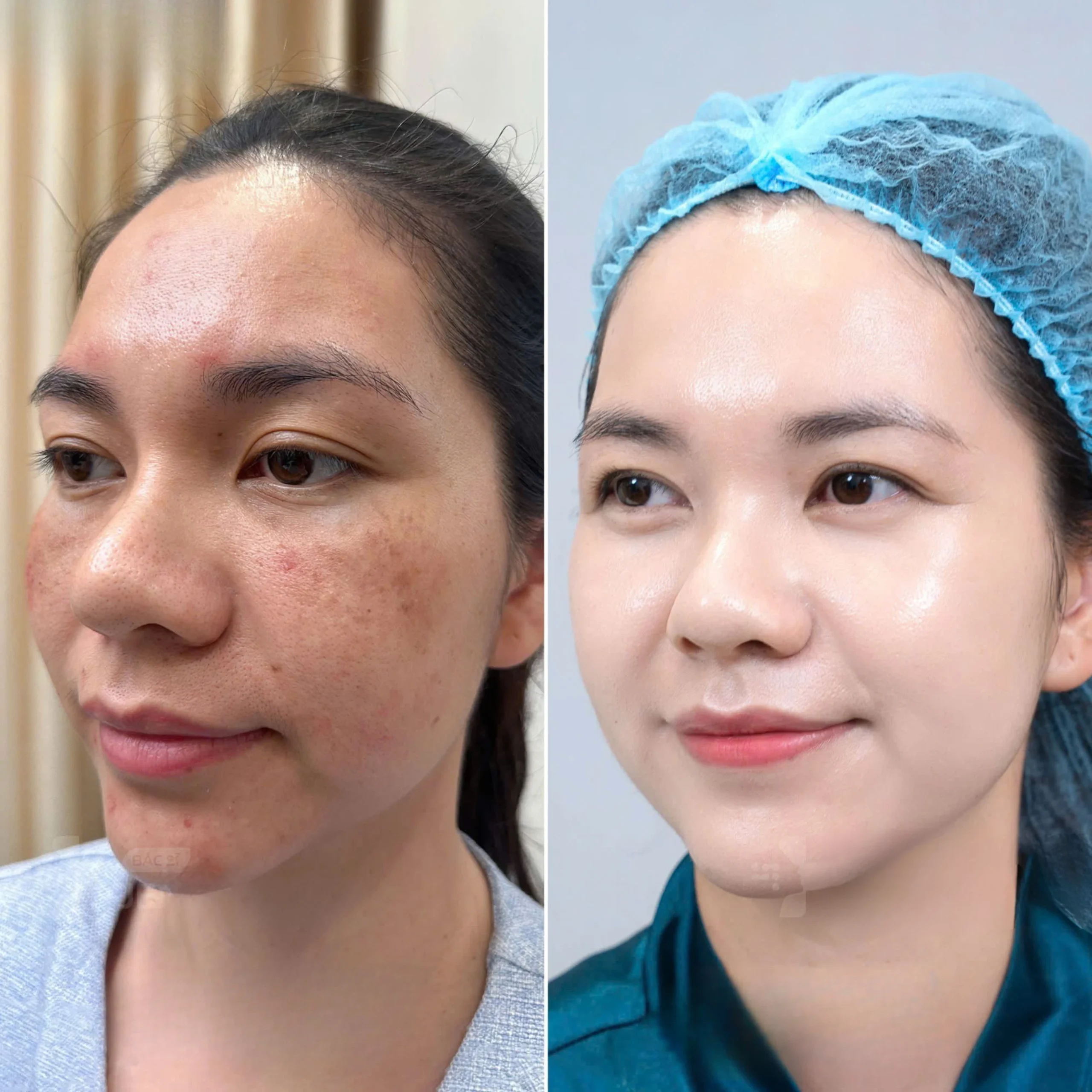 Trị Nám Bằng Laser Picosure Có Tốt Không?