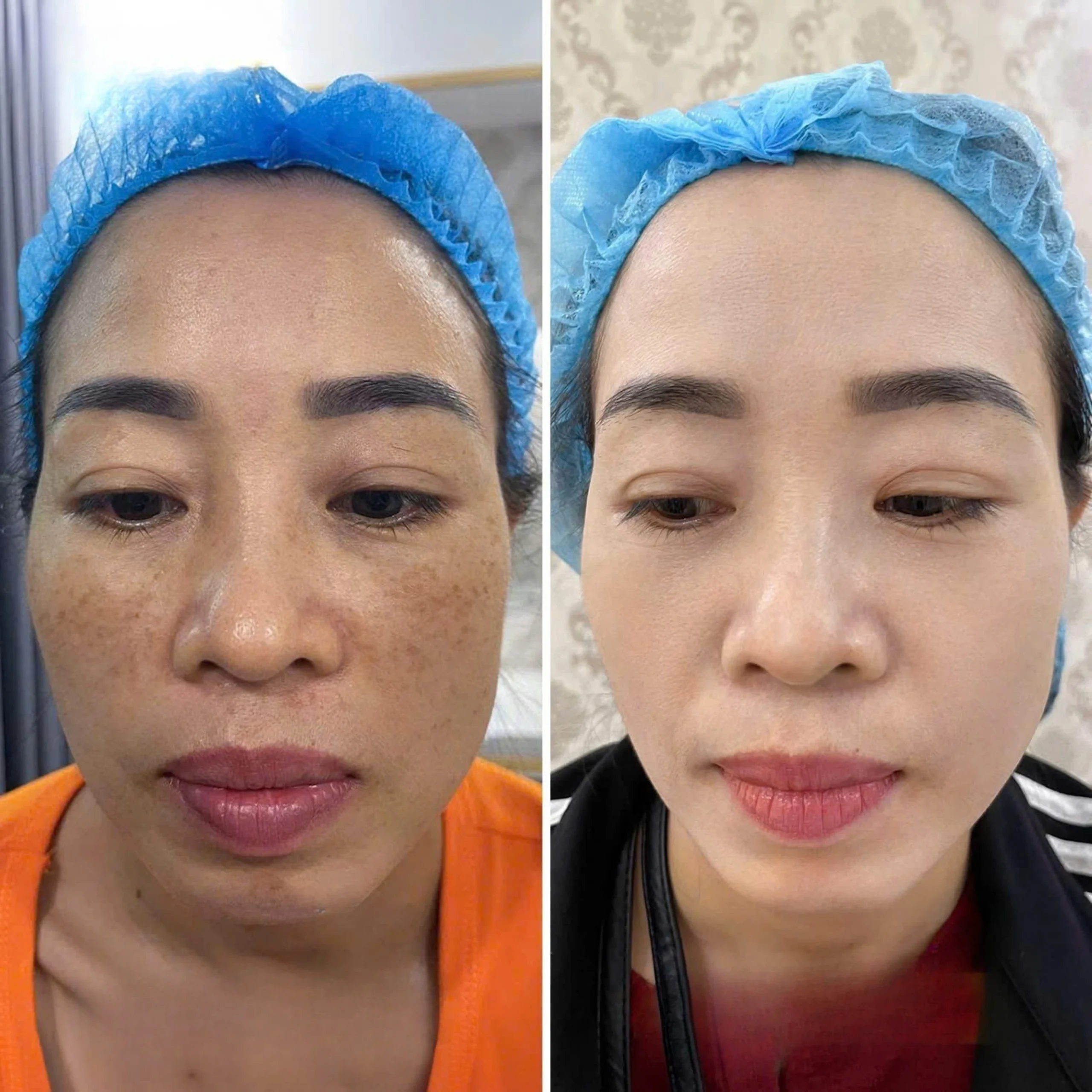 Trị Nám Bằng Laser Picosure Có Tốt Không?