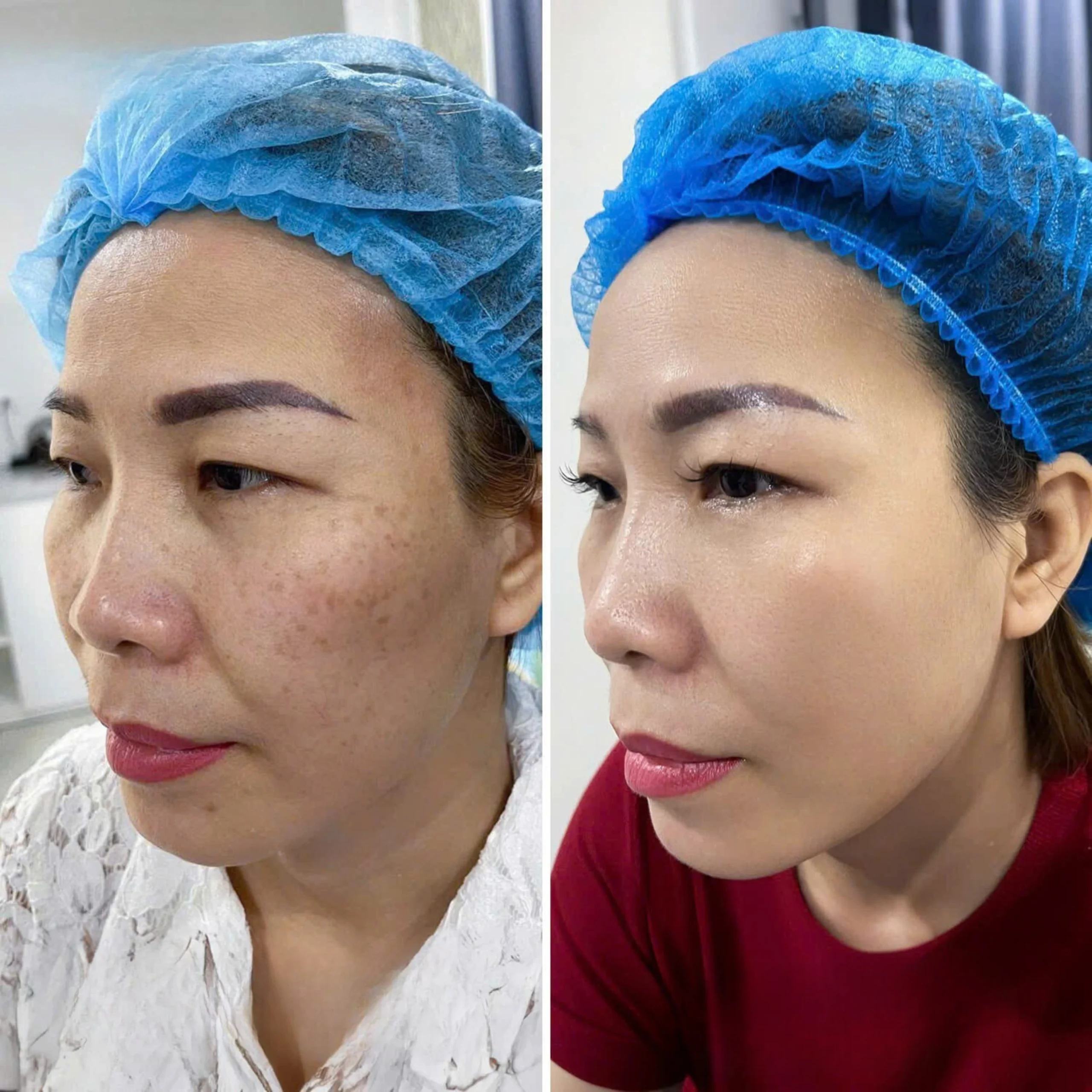 Trị Nám Bằng Laser Picosure Có Tốt Không?