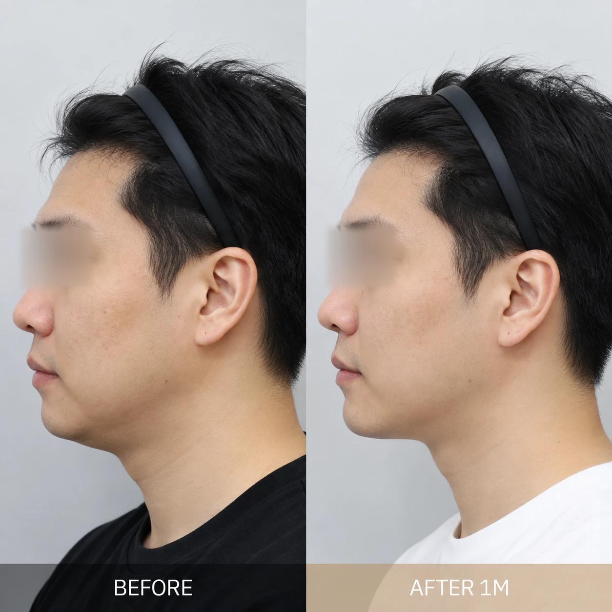Công Nghệ Nâng Cơ Trẻ Hóa Da HIFU Là Gì?
